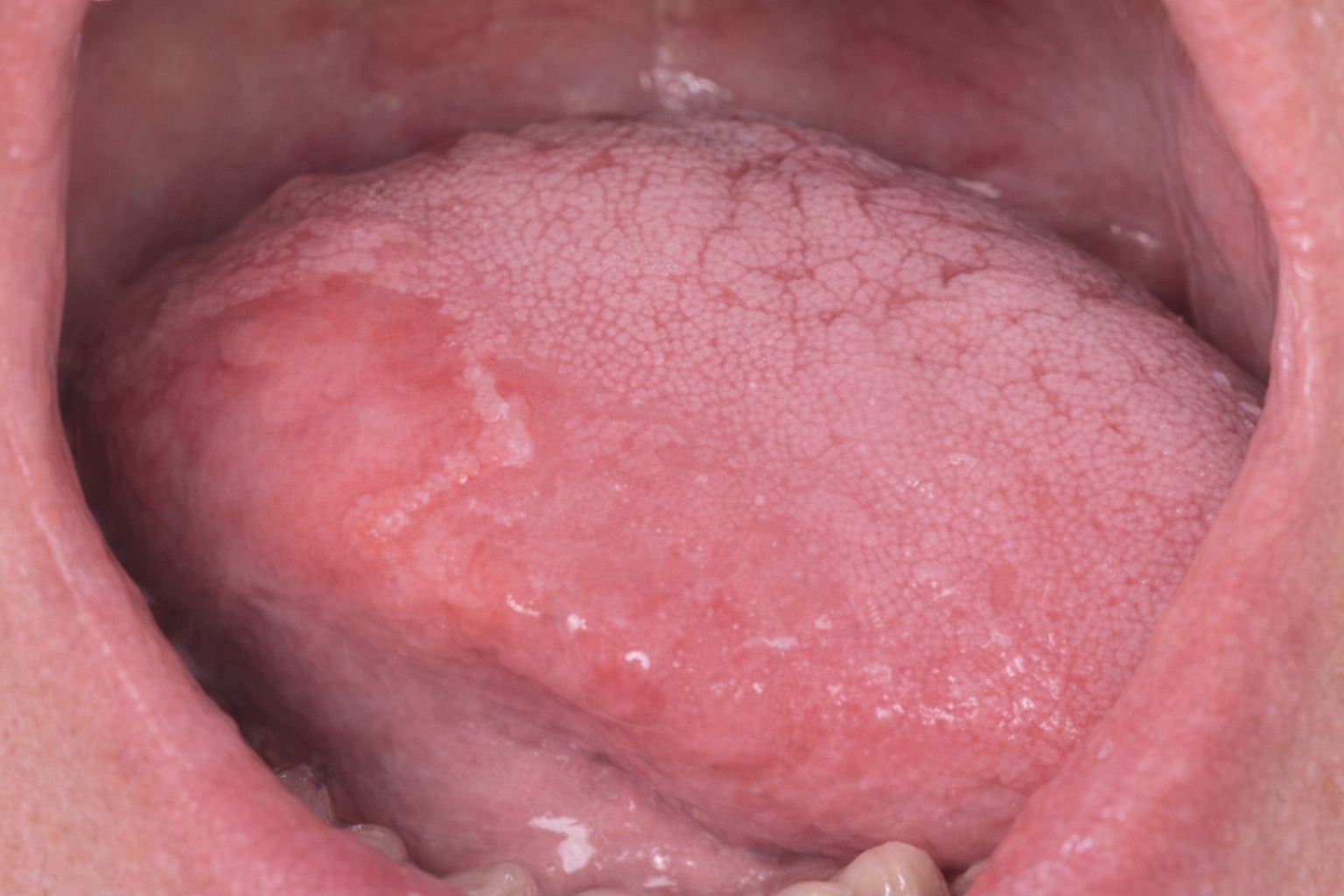 Nærbilde av en tunge med tegn på geografisk tunge med røde flekker.