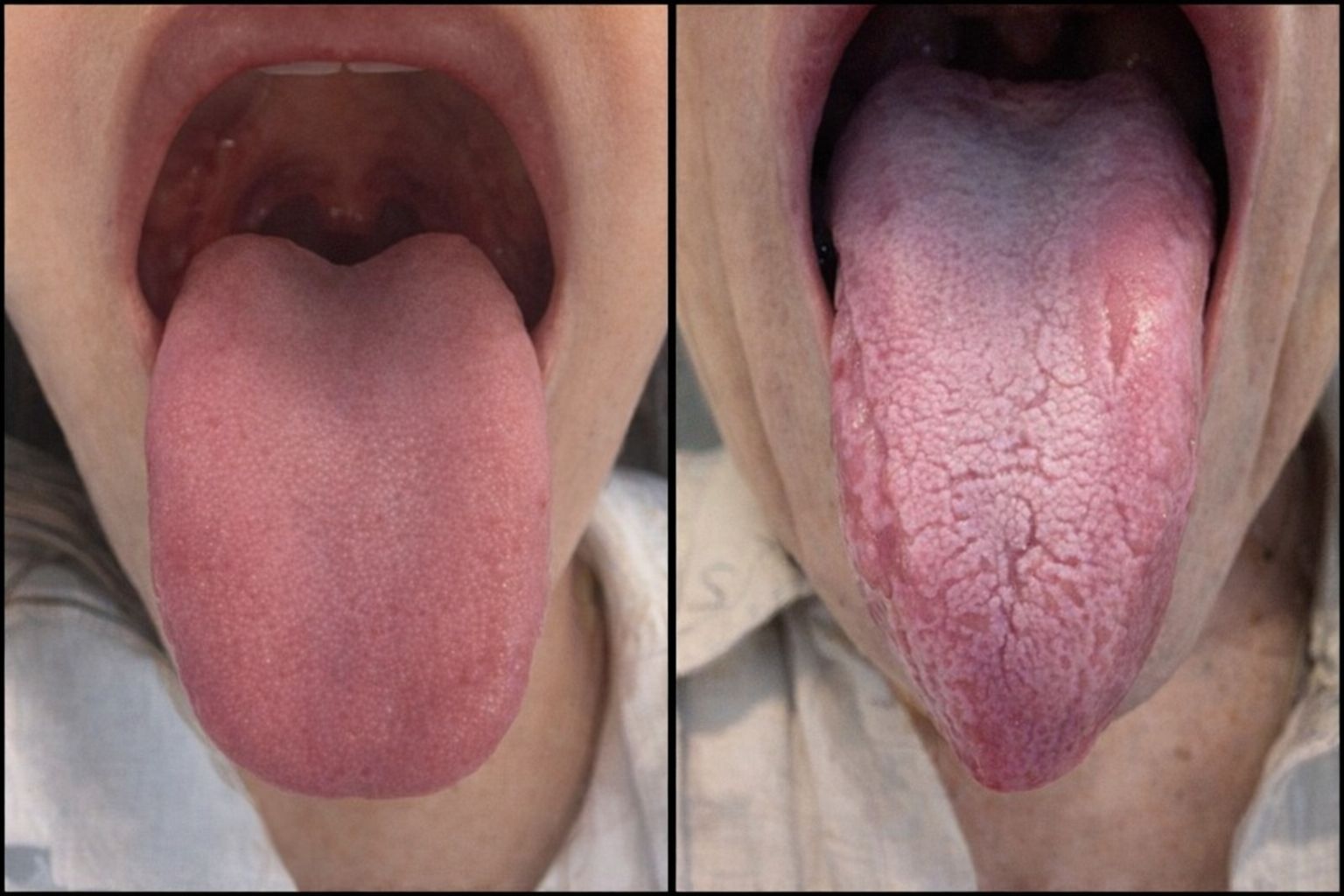 To nærbilder av tunger: venstre glatt og rosa, høyre med lyse, kartlignende felter.